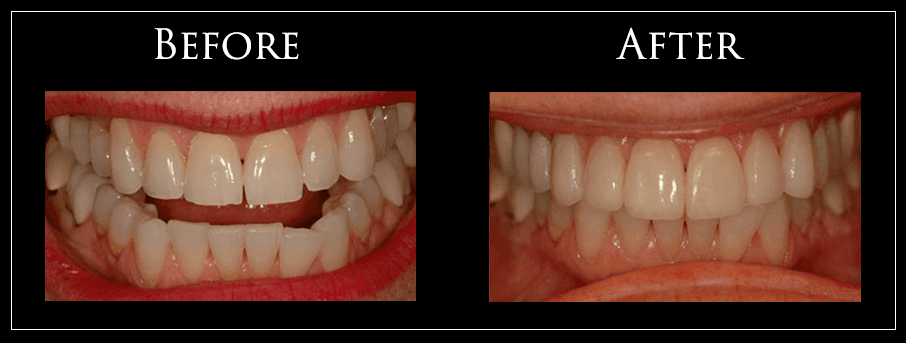 Before and After