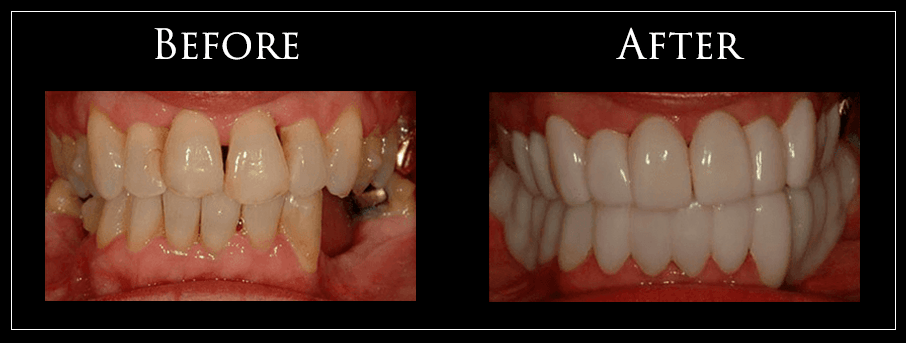 Before and After