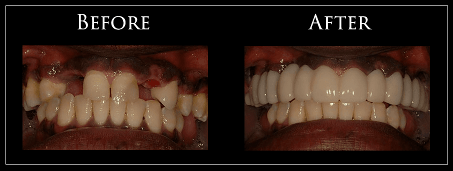 Before and After