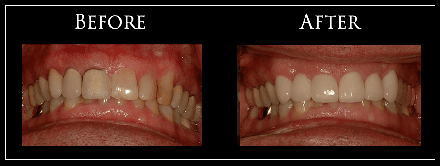 Before and After