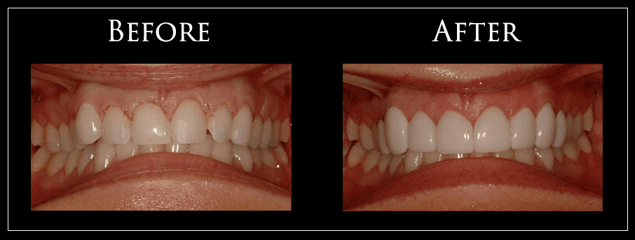 Before and After